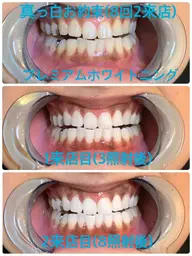 【真っ白お約束🦷】2来店合計70分✨短期間で早く綺麗に✨当店no1人気メニューになります♪※ジェル別途