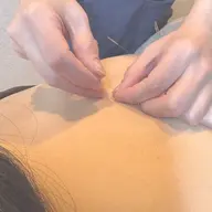 【初回限定】鍼灸施術