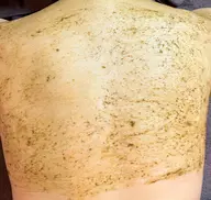 【背中集中ケア】💚剥離なしハーブピーリング+セラミド保湿パック付き8800円💚背中ニキビ、ニキビ跡に!男性にも人気!