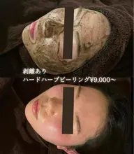 【キャンペーン】剥離ありハード･ハーブピーリング🌿がっつり皮剥けしたい方‼️ダウンタイム5​〜​7日間あり✨