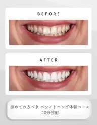 【歯を白くしたい方】医療ホワイトニング✨18000→条件付き1980円or8800円→1980円で受けられる!