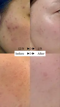 初回限定‼️  女性限定‼️　カウンセリング➕超音波フェイシャルエステ