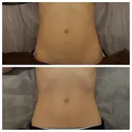 《症例モデルさん募集》ボディコースのびふぉーあふたー撮らせてください🙇‍♀️