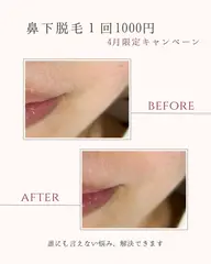 4月限定キャンペーン✨鼻下脱毛1回¥1,000‼️