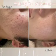 剥離ありハーブピーリング&保湿パック🌿ハード