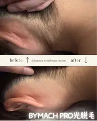 【イオン導入同時照射】光エステ脱毛«お顔・VIO込»