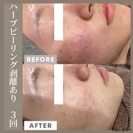 【ニキビ肌専用】ハーブピーリング剥離あり(2回目以降)/翌日メイクOK