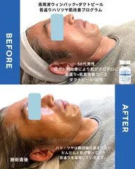 【お昼限定】シミシワたるみ対策！水素高周波のWアプローチ！フェイシャルエステコース初回