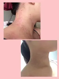 アトピーコース