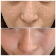 【圧倒的人気No1】ハリ•ツヤ•美白•赤ちゃん肌/REVIハーブピーリング/まずはお試し20000円→8800円