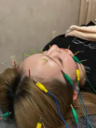 新規限定✨内側から超極細鍼電気でアプローチ！⚡️電気美容鍼小顔コース💖