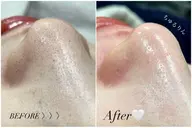 🥇人気No. 1🥇【艶肌フェイシャルワックス脱毛➕炭酸ガスパック】毛穴、産毛、角質、顔ダニさようなら♡