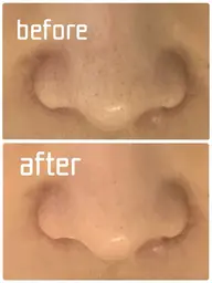 いちご鼻・黒ずみ毛穴ケア✨ソフトピーリングフェイシャル　40分