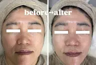 引き締め小顔❤️‍🔥エステメニュー人気No.1👑✨【たるみ・シワケアお悩み改善コース】
