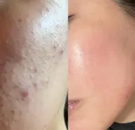 [ニキビ、ニキビ跡お悩みの方]韓国産🇰🇷剥離アリハーブピーリング🌿