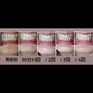 【 1回30分あたり/¥3,571 】セルフホワイトニング回数券 7回