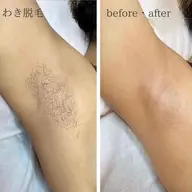 【初回4月限定🌸】両わき脱毛✨男女共OK