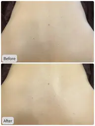 【特別価格！】背中美肌ケア★ハーブピーリングでツル肌をGET