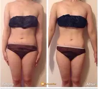 【2部位選択】キャビ&ラジオ波&リンパ70分￥16800→￥5900ダイエット！