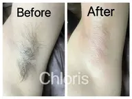 【Wax脱毛】両わきワックス脱毛