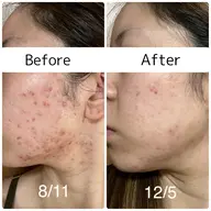 ミニモ限定特別価格🔥🔥【ニキビ撃退コース】