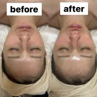 WINBACKフェイシャル30分＋WiQoワイコ®️水光ピーリング