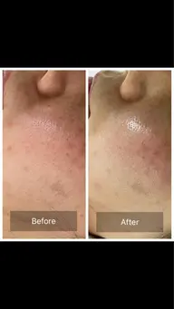 ハーブピーリング　剥けないタイプ