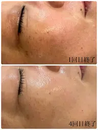 バクテリウムピール(ピーリング)