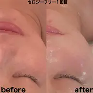 ゼロジーフリーリフトアップフェイシャル