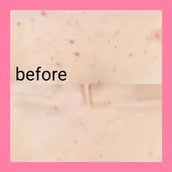 【デコルテ×谷間ケア】(3step)毛穴洗浄でデコルテ+谷間のニキビケア!パック付¥4500※ブライダルの方もオススメ♪