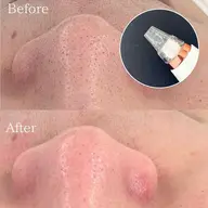 ニョキっと角栓・黒毛穴撃退!!毛穴集中改善フェイシャル