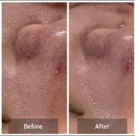 【男女OK】毛穴洗浄+保湿フェイシャル