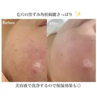 ハイドラ毛穴洗浄