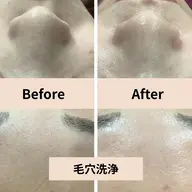 4月15日限定【毛穴洗浄/黒ずみ/ざらつき】毛穴すっきり洗浄＋保湿ケア