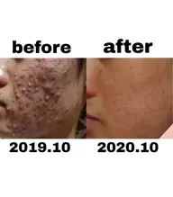 ニキビ撃退コース