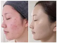 【ニキビ肌3ヶ月プログラム】　　　　　　　　　　　　　モニター価格　　　　　　　　　　　　　　　　(都度払い分割OK！)