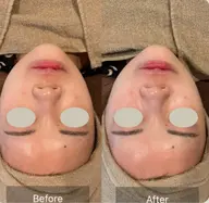 【中目黒人気No.1】小顔オンリフト+次世代角質トリートメント