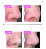 顔全部！毛穴洗浄🧼ハイドロスプラッシュ🛁