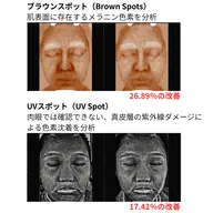 くすみ　色素沈着　最強　スピキュールピーリング