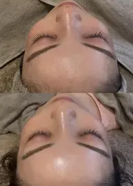 人気No2✨【黒ずみ.毛穴詰まり👃スッキリ】毛穴洗浄🌪️＋電気美容鍼⭐️エレクトロポレーション導入付き学割◎