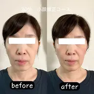 【Open記念✨️今月限定先着10名！条件付きで特別価格】　韓国LED美顔器＋小顔矯正40分コース #肌質改善#小顔