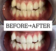 【まずはご相談されたい方★】セルフホワイトニング無料カウンセリング¥0