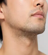 【超ヒゲ脱毛】3回