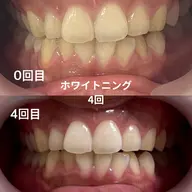 セルフホワイトニング 15分 6,200円→3,300円