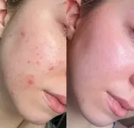 ニキビ専用メニュー🌹徹底的ニキビ退治😶‍🌫️毛穴洗浄✨プラズマ&よもぎ泡パック🫧で殺菌保湿！