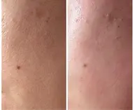 お顔全体ワックス脱毛で毛穴ケア♪潤艶美肌へ♪