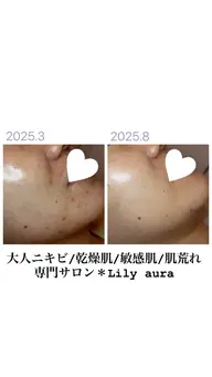 人気No. 1🏆肌荒れ改善/翌日のお化粧ノリばっちり👍お鼻つるつる、むくみ撃退、つや肌仕上げ/痛み・ダウンタイムなし