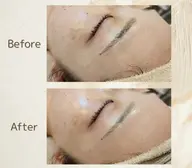 【学割 U24】ニキビ予防ケアシェービング