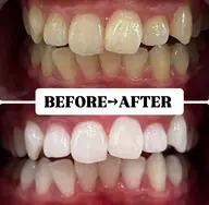 【minimo特別セール価格★】お試し♪速攻効果実感！美白ホワイトニング20分×2回照射¥1,500