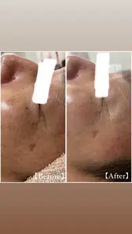 当店人気No.3メニュー✨️【 若化ケア 】 REVIハーブピーリング🌿